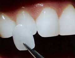 dental veneers nanaimo cosmetic dentists